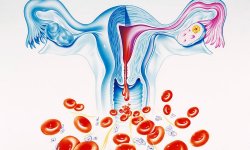 Как остановить обильную менструацию с наступлением климакса?