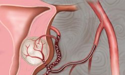 Что такое эмболизация маточных артерий?