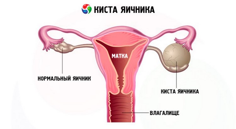Операция по удалению кисты яичника в период менопаузы