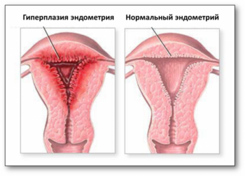 Норма и гиперплазия эндометрия