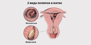 Полипы в матке во время менопаузы