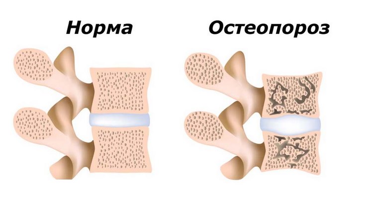 Причины остеопороза при климаксе thumbnail