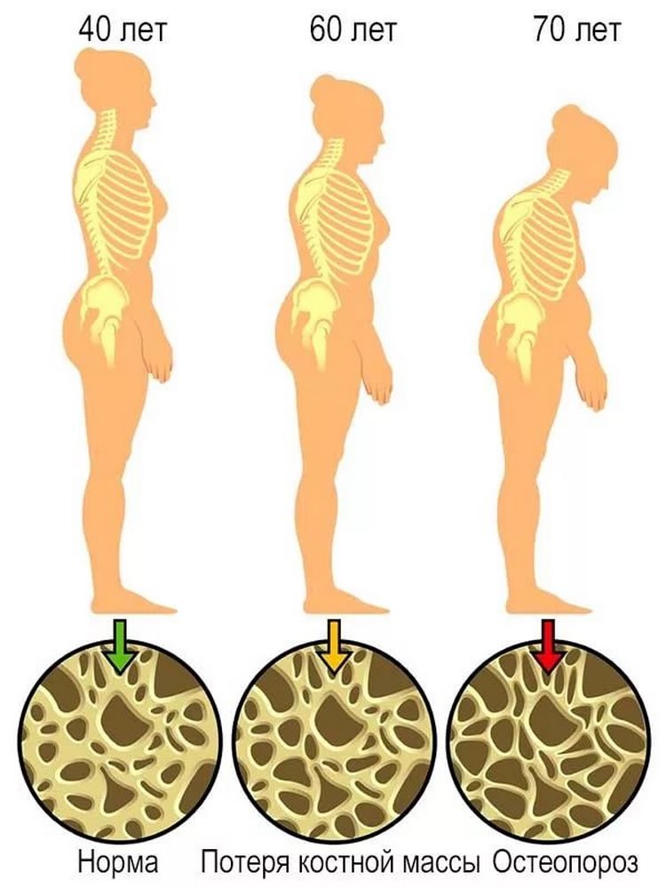 Причины остеопороза у женщин при менопаузе thumbnail
