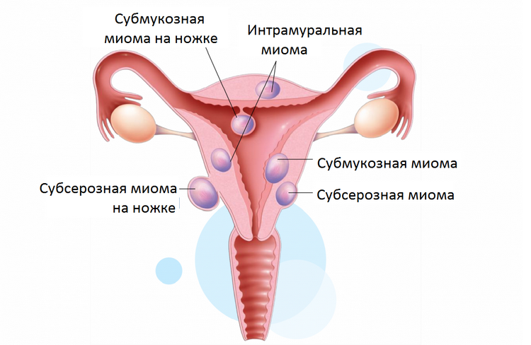Многоузловая интрамуральная миома матки