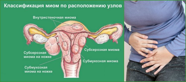 Миома матки интрамуральная форма лечение