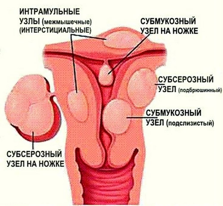 Миома на задней стенке матки. Интрамурально-субмукозный узел. Субсерозно-субмукозно интерстициальная миома матки. Субсерозно интерстициальный узел миома. Субсерозные миоматозные узлы матки что.