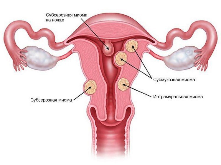 Что такое миома тела матки с субсерозным ростом узла thumbnail