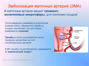 Эмболизация маточных артерий ЭМА